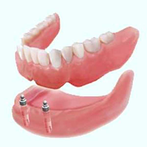 Single tooth implant